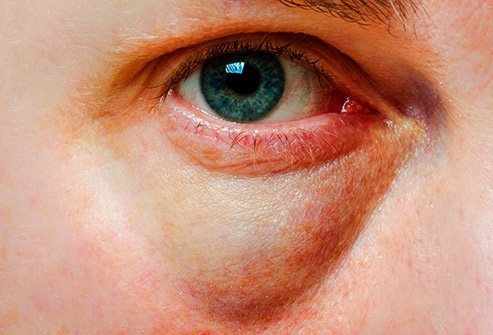 One cause of puffy bags under your eyes is exhaustion.