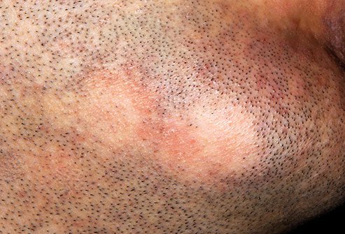 Facial hair loss from alopecia affects an estimated 6.8 million Americans.