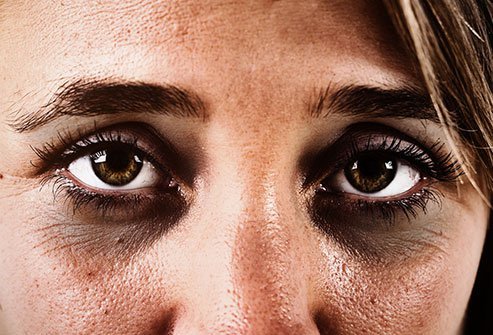 Dark circles under your eyes may have a wide variety of causes and treatments.
