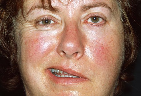 Bell's palsy can be responsible for facial paralysis.