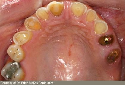 Tooth erosion seems to be an early and important sign of an eating disorder. Self-induced vomiting may wear away the tooth enamel over time. Dentists can be the first to spot this problem during a routine checkup.