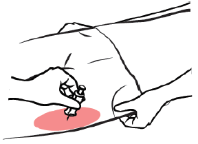 Embed the needle completely before transferring the thumb to the syringe plunger - Illustration