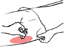 ZIMHI is injected downwards, into the middle of the outer thigh - Illustration