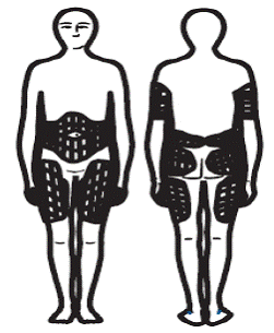 Choosing an Injection Site - Illustration