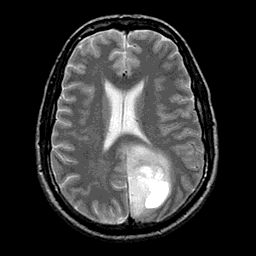 Brain tumor (glioma) on MRI may cause headaches attributed to increased intracranial pressure or hydrocephalus caused by neoplasm.