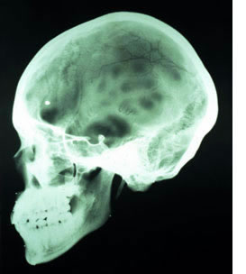Routine x-ray examination discloses skull fractures.