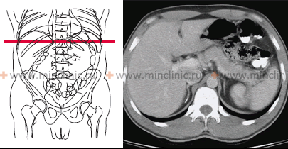 Abdominal CT scan in the axial plane (can be seen lobe of the liver, bowel loops, pancreas, stomach, aorta, adrenal gland).