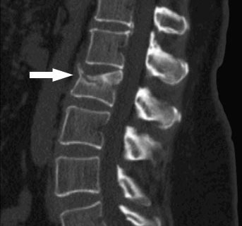 Lumbar spine computed tomography (CT) scan reveal L1 vertebral compression fracture.