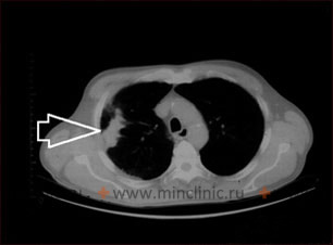 На компьютерной томографии (КТ) грудной клетки выявлена опухолевая масса в правом лёгком (указана стрелокй).