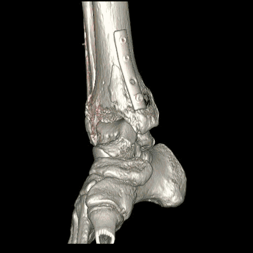 Diagnostic procedure computed tomography (CT) after surgery with fixation of fracture of ankle bones.