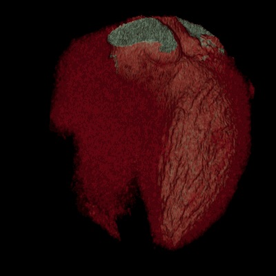 The three-dimensional image reconstruction of coronary arteries during coronary CT-angiography and heart computed tomography procedures. Visible calcification with narrowing of the lumen of blood vessels in the heart.