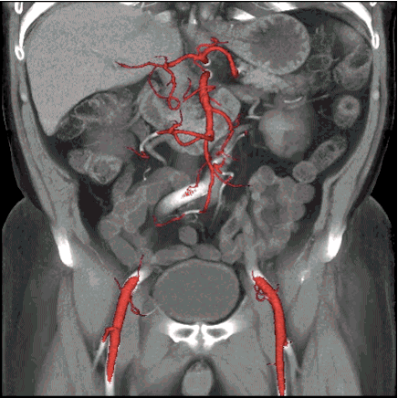 Computed angiography (CT) of the abdomen and the abdominal aorta in the frontal plane (can be seen lobe of the liver, bowel loops, pancreas, stomach, abdominal aorta, adrenal gland).