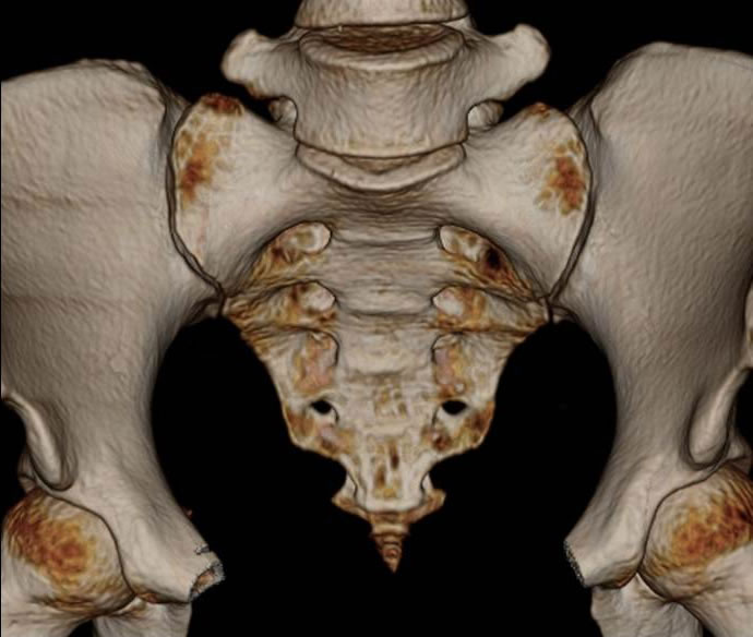 Computed tomography (CT) of the pelvic bones (sacrum, ilium) makes it possible to exclude the oncological nature of the lesion of the sacrum or vertebrae in a patient with sacroiliitis.