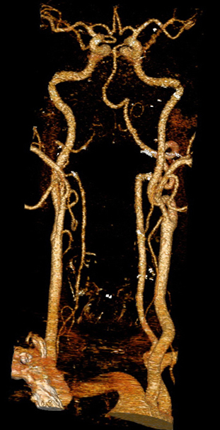 კისრისა და თავის ტვინის სისხლძარღვთა კომპიუტერულ ანგიოგრაფიაზე ნაჩვენებია ხერხემლის და საძილე არტერიები (ხედი წინიდან).