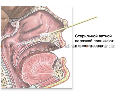 При насморке лечебными средствами промазывают переднюю часть носа указательным пальцем или ватной палочкой.