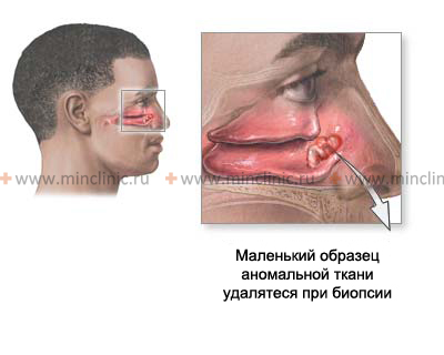 Benign nasal tumors - angiomas, papillomas, fibromas, pigmented tumors (nevi), tumor-like formations.