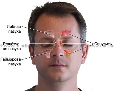 Острый фронтит (воспаление лобной пазухи) сопровождается головной болью в области лба и за глазами, повышением температуры тела.