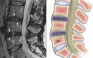 Magnetic resonance imaging of the lumbosacral spine, intervertebral protrusion (prolapse) of the L3 – L4 and L4 – L5 discs.