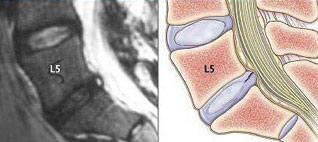 Магнитно-резонансная томография (МРТ) пояснично-крестцового отдела позвоночника, разрыв фиброзного кольца межпозвонкового диска L5–S1.