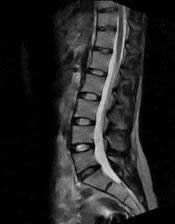 Magnetic resonance imaging (MRI) of the lumbosacral spine, sagittal projection.