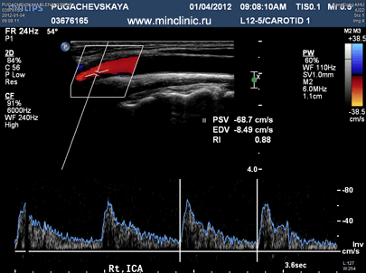 Doppler ultrasonography in the diagnosis of cervical vessels.