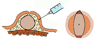 Этап операции: обезболивание кожи перед разрезом вокруг атеромы новокаином или лидокаином.