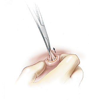 Удаление капсулы сальной железы во время операции необходимо для профилактики возможного рецидива атеромы на этом месте.
