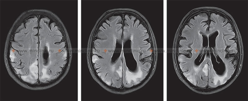 Преимущественно заднее расположение очагов поражения на МРТ головного мозга (на Т2-взвешенных изображениях), без четкой привязки к сосудистому руслу той или иной мозговой артерии, соответствуют синдрому MELAS (митохондриальная энцефаломиопатия, лактатацидоз и инсультоподобные эпизоды).