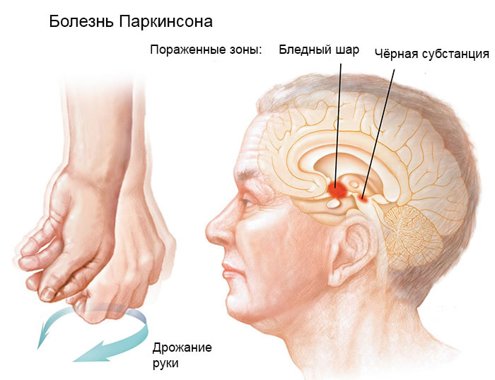 Болезнь Паркинсона - это прогрессирующее расстройство нервной системы, которое влияет на движение.