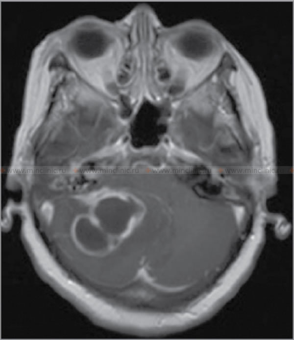 თავის ტვინის აქსიალური მაგნიტურ-რეზონანსული (MRI) ტომოგრაფია T1-შეწონილ რეჟიმში. თავის ტვინის მაგნიტურ-რეზონანსული ტომოგრაფია (MRI) კონტრასტული ნივთიერების (გადოლინიუმი) გამოყენებით ავლენს მენინგიტს და რგოლში მოთავსებულ დიდი ზომის ტვინის ქსოვილის დაზიანებას.