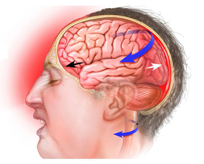 ტვინის შერყევა არის თავის ტვინის ტრავმული დაზიანება, რომელიც გავლენას ახდენს მის ფუნქციაზე.