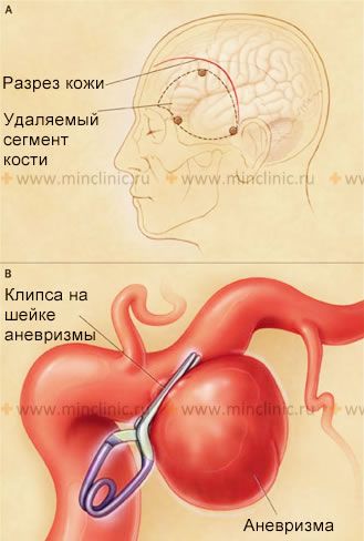 Мешковидная аневризма мозговой артерии и субарахноидальное кровоизлияние Этапы операции (А, В) по клиппированию шейки не разорвавшейся или разорвавшейся мешковидной аневризмы мозговой артерии.