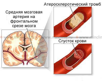 Закупорка просвета мозговой артерии может быть вызвана сгустком крови из полости сердца (эмболия) и атеросклеротическим процессом в самом сосуде.