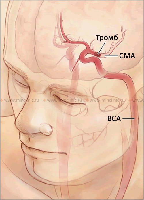 Тромбоэмболии инсульта. Эмболия сосудов головного мозга. Эмболия мозговых артерий. Эмболия артерии головного мозга. Внутренняя Сонная артерия.