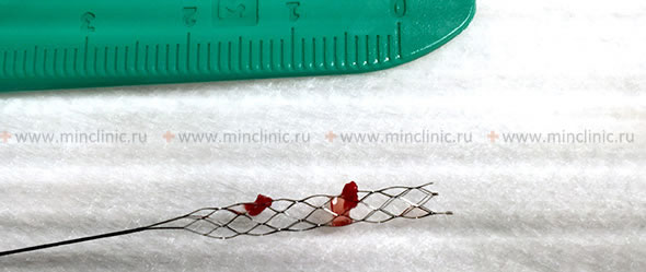 New generation stents with mesh can open up inside a blood clot. It allows extracting the whole embolus from the lumen of the occluded cerebral artery.