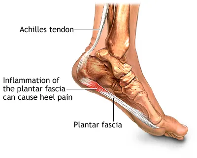 Plantar Fascia Anatomy Diagram showing the plantar fascia ligament on the bottom of the foot, the site of inflammation in plantar fasciitis.