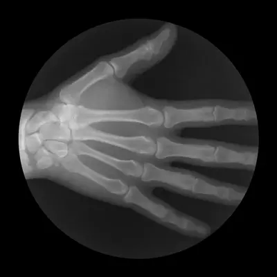 Рентгенография пальцев кисти при движении позволяет проконтролировать правильно проведённую репозицию при их вывихе.