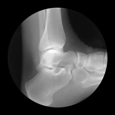 Radiography of the shin-talar joint motion allows control correctly reposition conducted by its dislocation.