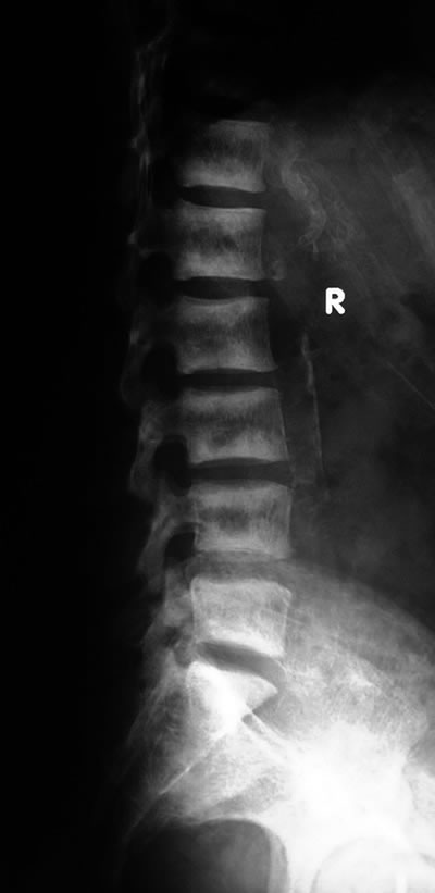 Lumbosacral spine radiograph reveal radiological appearances of secondary hyperparathyroidism ("rugger jersey spine") - alternating bands of sclerosis and lucency throughout the lumbar spine in patient with renal failure.