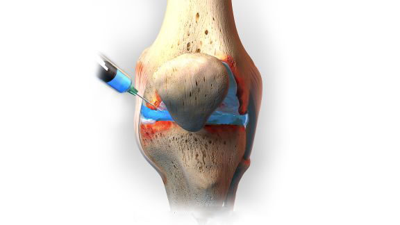 Hormons, platelet-enriched plasma (PRP) or artificial joint fluid can be injected into the knee joint cavity, which weakens the pain symptom and inflammation, and also promotes the regeneration of the articular (cartilaginous) surface.