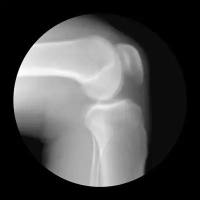 Рентгенография коленного сустава при движении позволяет проконтролировать правильно проведённую репозицию при его вывихе.