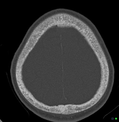 Hyperparathyroidism CT imagine of multiple tiny well defined lucencies in the skull vault caused by resorption of trabecular bone in hyperparathyroidism (Salt and pepper sign or pepperpot skull of the calvarium).