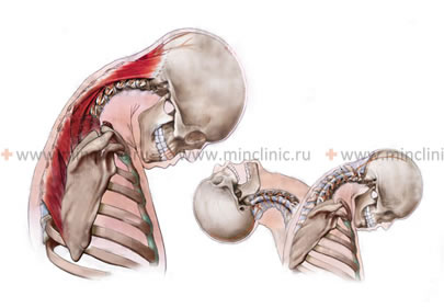 With the whiplash mechanism, injury to the ligaments and muscles of the neck (with a sharp nod of the head during a car accident or a collision while skating, rollerblading, skiing, or snowboarding), the neck hurts, the back of the head and dizzy.