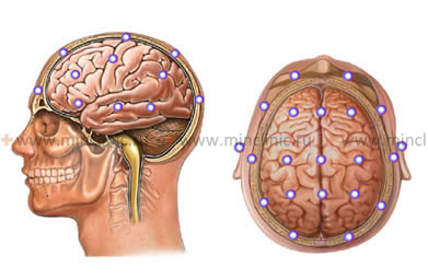 Расположение на черепе электродов для электроэнцефалографии (ЭЭГ) головного мозга.
