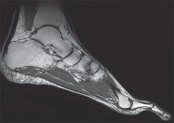 MRI of the ankle ligaments may sometimes be necessary in case of rupture of the Achilles tendon or its extension.