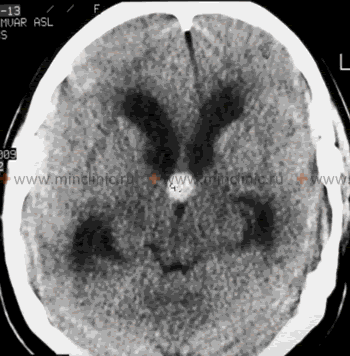 Компьютерная томография головного мозга (КТ) коллоидной кисты головного мозга в области 3 мозгового желудочка (может вызывать повышение внутричерепного давления с окклюзионной гидроцефалией с головной болью).