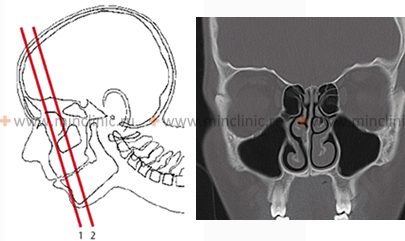Computer nasal tomography (CT) determines the depth of penetration of foreign bodies in the nasal cavity.