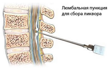 Lumbar puncture is used for measurement and management of raised intracranial pressure (ICP), rapid liquor sanation after intracranial hemorrhage.