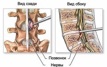 Access scheme during endoscopic surgery to remove a hernia or protrusion of the intervertebral disc of the lumbar spine.
