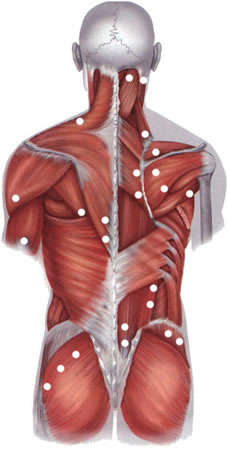Локализация типичных болевых триггерных точек при фибромиалгии (мышечной боли) при остеохондрозе грудного отдела позвоночника.